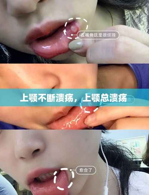 上颚不断溃疡,上颚总溃疡